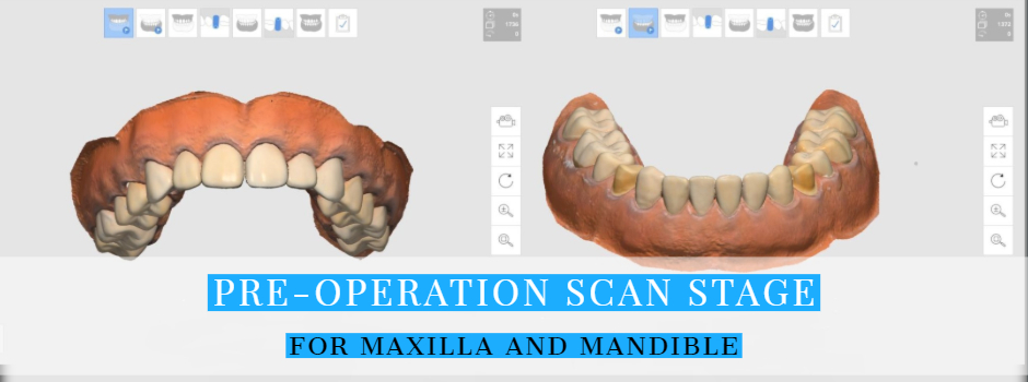New iScan Function: Pre-Operation Scan Stage