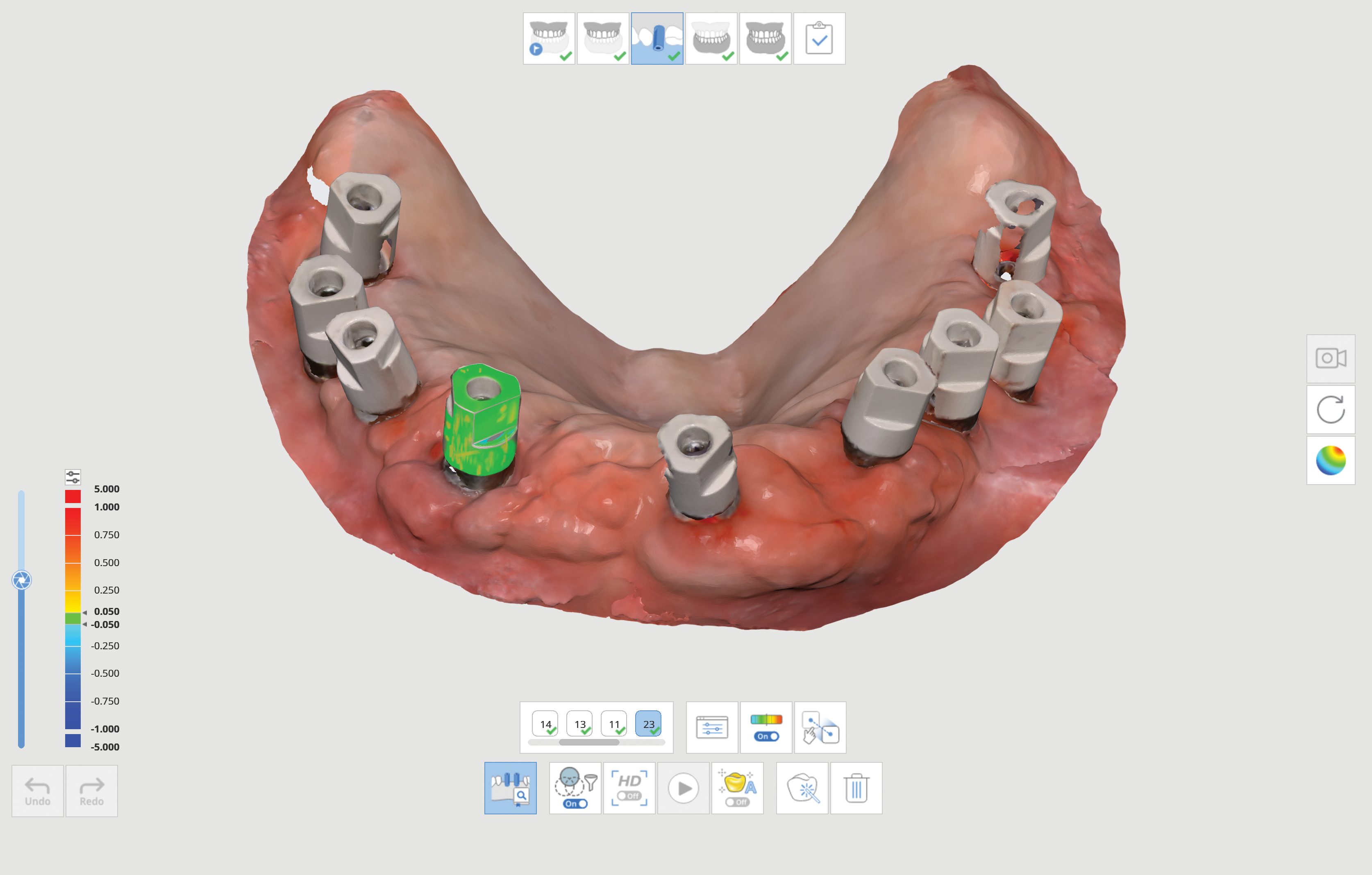 A.I. Scanbody & Abutment matchig