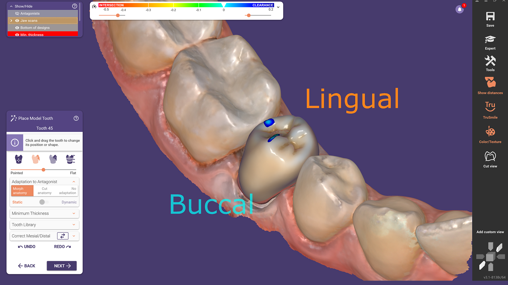 Lingual and Buccal