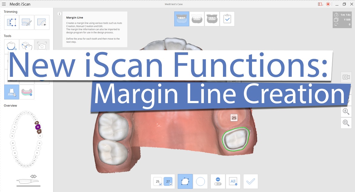 New iScan Functions: Margin Line Creation